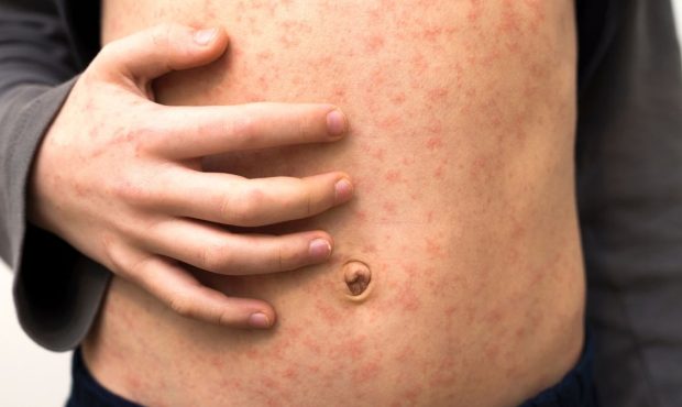 سرخک در اروپا: مواردی از یکی از مسری ترین بیماری های جهان در حال افزایش است؟ سرخک در اروپا: مواردی از یکی از مسری ترین بیماری های جهان در حال افزایش است؟